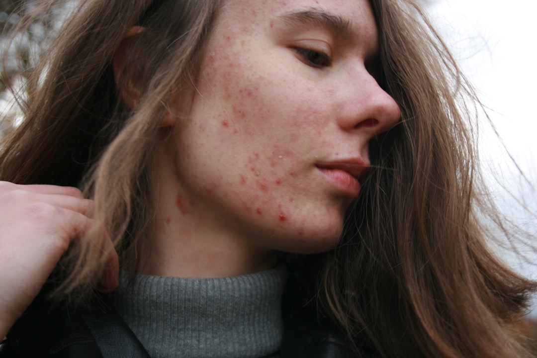 여드름(Acne) | 질환백과 | 의료정보 | 건강정보 | 서울아산병원