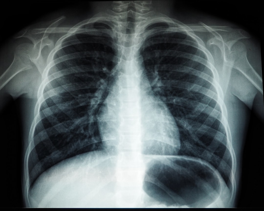 Thoracic Radiation Oncology Clinical Trial Accrual and Reasons for Nonenrollment: Results of a Large, Prospective, Multiyear Analysis.
